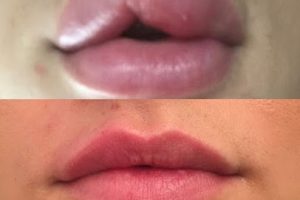 before and after fixed lips